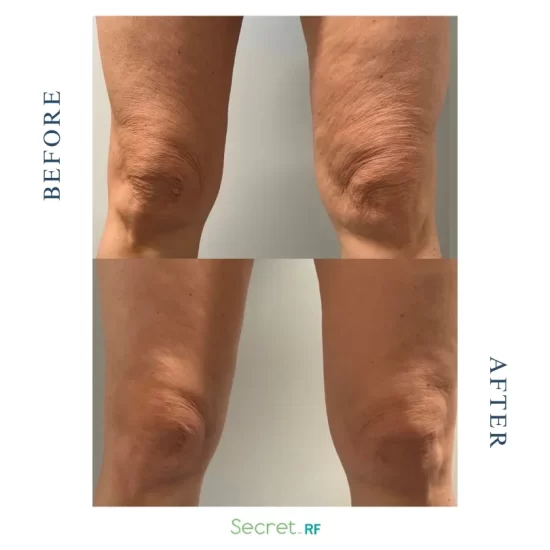 Secret RF Skin Tightening on Knees